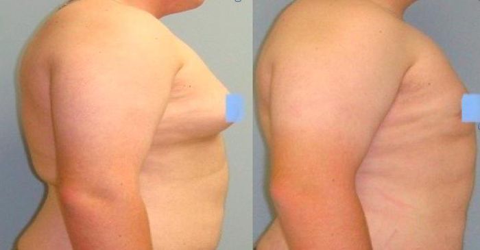 Hình ảnh bệnh nhân trước và sau phẫu thuật bệnh lý phì đại tuyến vú nam giới. Ảnh: BSCC