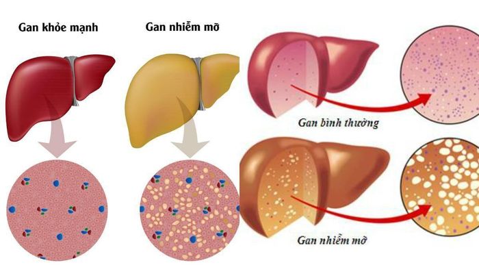 Hình ảnh gan nhiễm mỡ.