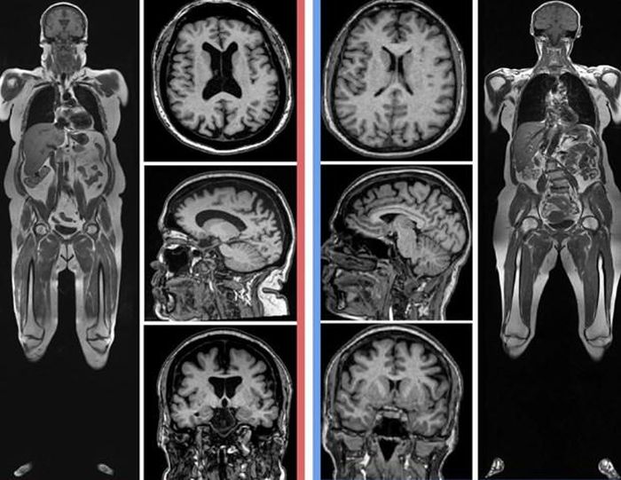 Chứng teo não xuất hiện rõ ràng với nhiều khoảng trống trong não ở người phụ nữ có lượng mỡ cơ thể cao hơn (bên trái). (Nguồn: Cyrus Raji)